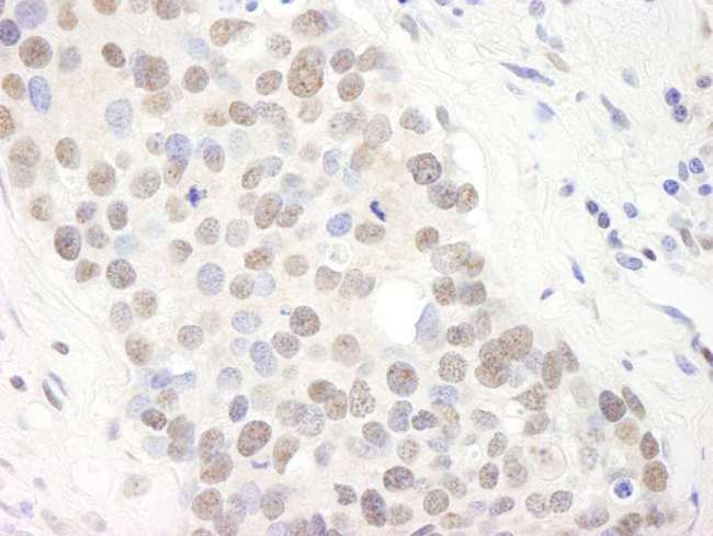 TRIM24 / TIF1 Antibody - Detection of Human TIF1 alpha/TRIM24 by Immunohistochemistry. Sample: FFPE section of human breast carcinoma. Antibody: Affinity purified rabbit anti-TIF1 alpha/TRIM24 used at a dilution of 1:1000 (0.2 ug/ml). Detection: DAB.