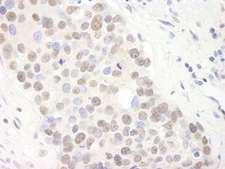 TRIM24 / TIF1 Antibody - Detection of Human TIF1 alpha/TRIM24 by Immunohistochemistry. Sample: FFPE section of human breast carcinoma. Antibody: Affinity purified rabbit anti-TIF1 alpha/TRIM24 used at a dilution of 1:1000 (0.2 ug/ml). Detection: DAB.