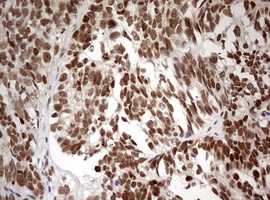TRIM24 / TIF1 Antibody - IHC of paraffin-embedded Adenocarcinoma of Human ovary tissue using anti-TRIM24 mouse monoclonal antibody. (Heat-induced epitope retrieval by 10mM citric buffer, pH6.0, 120°C for 3min).