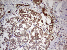 TRIM24 / TIF1 Antibody - IHC of paraffin-embedded Carcinoma of Human pancreas tissue using anti-TRIM24 mouse monoclonal antibody. (Heat-induced epitope retrieval by 10mM citric buffer, pH6.0, 120°C for 3min).