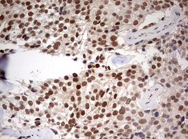 TRIM24 / TIF1 Antibody - IHC of paraffin-embedded Carcinoma of Human prostate tissue using anti-TRIM24 mouse monoclonal antibody. (Heat-induced epitope retrieval by 10mM citric buffer, pH6.0, 120°C for 3min).