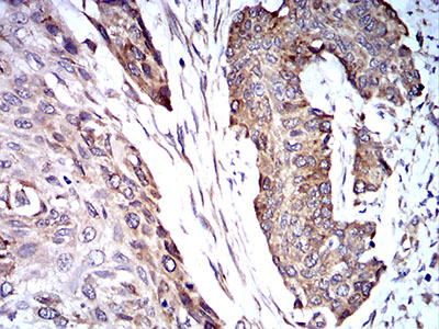 TRIM25 Antibody - Immunohistochemical analysis of paraffin-embedded esophageal cancer tissues using TRIM25 mouse mAb with DAB staining.