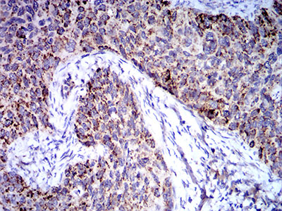 TRIM25 Antibody - Immunohistochemical analysis of paraffin-embedded cervical cancer tissues using TRIM25 mouse mAb with DAB staining.