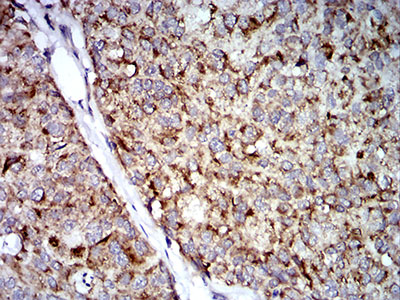 TRIM25 Antibody - Immunohistochemical analysis of paraffin-embedded bladder cancer tissues using TRIM25 mouse mAb with DAB staining.