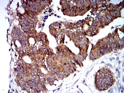 TRIM25 Antibody - Immunohistochemical analysis of paraffin-embedded rectum cancer tissues using TRIM25 mouse mAb with DAB staining.