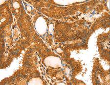 TRIM25 Antibody - Immunohistochemistry of paraffin-embedded Human breast cancer using TRIM25 Polyclonal Antibody at dilution of 1:40.