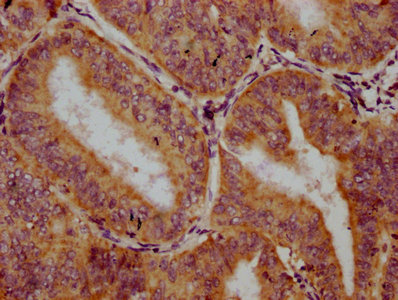 TRIM26 Antibody - Immunohistochemistry Dilution at 1:300 and staining in paraffin-embedded human endometrial cancer performed on a Leica BondTM system. After dewaxing and hydration, antigen retrieval was mediated by high pressure in a citrate buffer (pH 6.0). Section was blocked with 10% normal Goat serum 30min at RT. Then primary antibody (1% BSA) was incubated at 4°C overnight. The primary is detected by a biotinylated Secondary antibody and visualized using an HRP conjugated SP system.