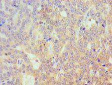 TRIM27 Antibody - Immunohistochemistry of paraffin-embedded human rectal cancer using antibody at 1:100 dilution.
