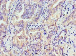 TRIM27 Antibody - Immunohistochemistry of paraffin-embedded human lung cancer using antibody at 1:100 dilution.