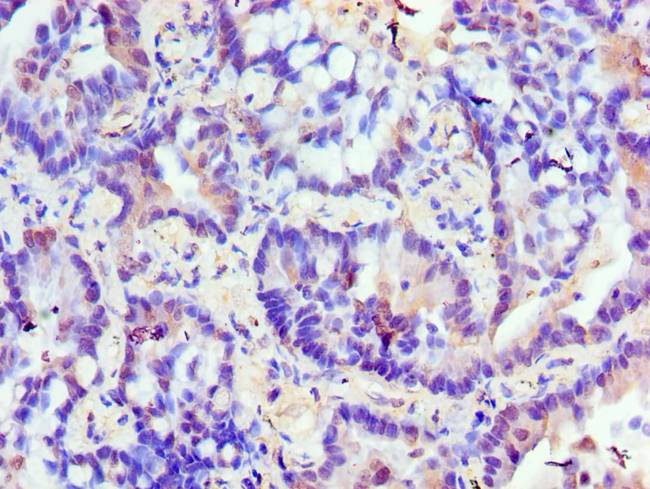 TRIM27 Antibody - Immunohistochemistry of paraffin-embedded human lung cancer using TRIM27 Antibody at dilution of 1:100