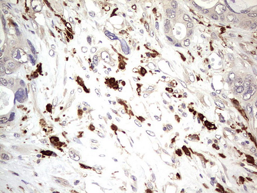 TRIM27 Antibody - IHC of paraffin-embedded Adenocarcinoma of Human colon tissue using anti-TRIM27 mouse monoclonal antibody. (Heat-induced epitope retrieval by 1 mM EDTA in 10mM Tris, pH8.5, 120°C for 3min).