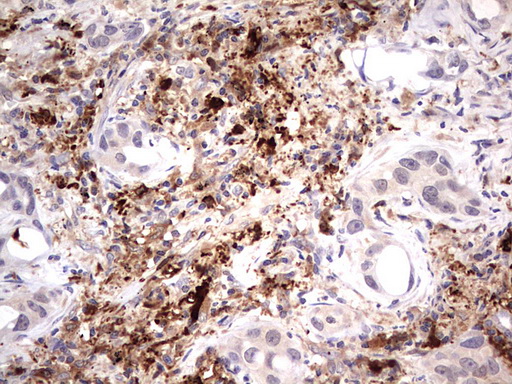 TRIM27 Antibody - IHC of paraffin-embedded Carcinoma of Human lung tissue using anti-TRIM27 mouse monoclonal antibody. (Heat-induced epitope retrieval by 1 mM EDTA in 10mM Tris, pH8.5, 120°C for 3min).