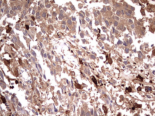 TRIM27 Antibody - IHC of paraffin-embedded Adenocarcinoma of Human ovary tissue using anti-TRIM27 mouse monoclonal antibody. (Heat-induced epitope retrieval by 1 mM EDTA in 10mM Tris, pH8.5, 120°C for 3min).