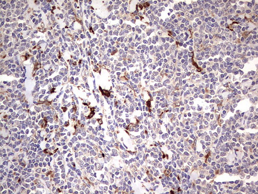 TRIM27 Antibody - IHC of paraffin-embedded Human lymphoma tissue using anti-TRIM27 mouse monoclonal antibody. (Heat-induced epitope retrieval by 1 mM EDTA in 10mM Tris, pH8.5, 120°C for 3min).