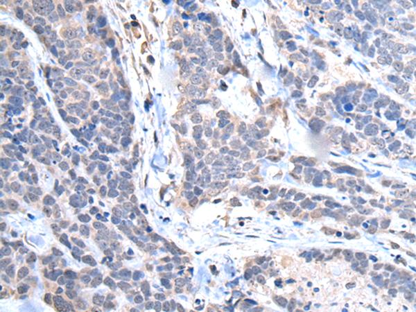 TRIM27 Antibody - Immunohistochemistry of paraffin-embedded Human thyroid cancer tissue  using TRIM27 Polyclonal Antibody at dilution of 1:65(×200)
