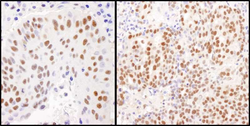 TRIM28 / KAP1 Antibody - Detection of Human KAP-1 by Immunohistochemistry. Sample: FFPE sections of human lung carcinoma (left) and ovarian carcinoma (right). Antibody: Affinity purified rabbit anti-KAP-1 used at a dilution of 1:5000 (0.2and 1:1000 (1 Detection: DAB.