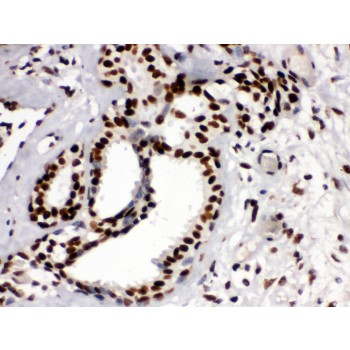TRIM28 / KAP1 Antibody - KAP1 antibody IHC-paraffin. IHC(P): Human Mammary Cancer Tissue.
