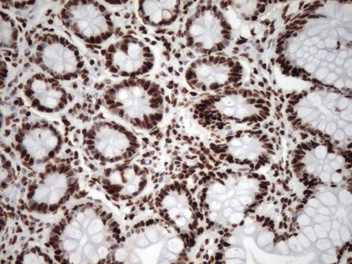 TRIM28 / KAP1 Antibody - Immunohistochemical staining of paraffin-embedded Human colon tissue within the normal limits using anti-TRIM28 mouse monoclonal antibody. (Heat-induced epitope retrieval by 1mM EDTA in 10mM Tris buffer. (pH8.5) at 120°C for 3 min. (1:500)