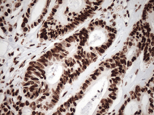 TRIM28 / KAP1 Antibody - Immunohistochemical staining of paraffin-embedded Adenocarcinoma of Human colon tissue using anti-TRIM28 mouse monoclonal antibody. (Heat-induced epitope retrieval by 1mM EDTA in 10mM Tris buffer. (pH8.5) at 120°C for 3 min. (1:500)