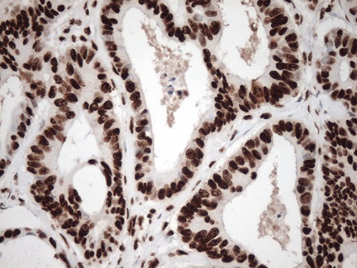 TRIM28 / KAP1 Antibody - Immunohistochemical staining of paraffin-embedded Adenocarcinoma of Human colon tissue using anti-TRIM28 mouse monoclonal antibody. (Heat-induced epitope retrieval by 1mM EDTA in 10mM Tris buffer. (pH8.5) at 120°C for 3 min. (1:500)