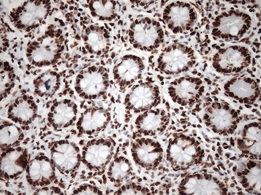 TRIM28 / KAP1 Antibody - Immunohistochemical staining of paraffin-embedded Human colon tissue within the normal limits using anti-TRIM28 mouse monoclonal antibody. (Heat-induced epitope retrieval by 1mM EDTA in 10mM Tris buffer. (pH8.5) at 120°C for 3 min. (1:500)