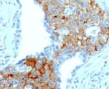TRIM29 Antibody - Formalin-fixed, paraffin-embedded human lung squamous cell carcinoma stained with TRIM29 antibody (TRIM29/1041).  This image was taken for the unmodified form of this product. Other forms have not been tested.