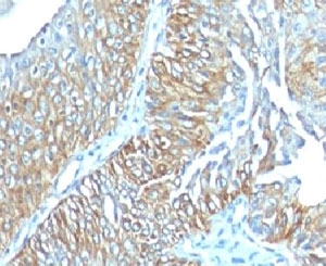 TRIM29 Antibody - Formalin-fixed, paraffin-embedded human esophageal carcinoma stained with TRIM29 antibody (TRIM29/1041).  This image was taken for the unmodified form of this product. Other forms have not been tested.