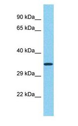 TRIM29 Antibody - TRIM29 antibody Western Blot of Lung tumor. Antibody dilution: 1 ug/ml.  This image was taken for the unconjugated form of this product. Other forms have not been tested.