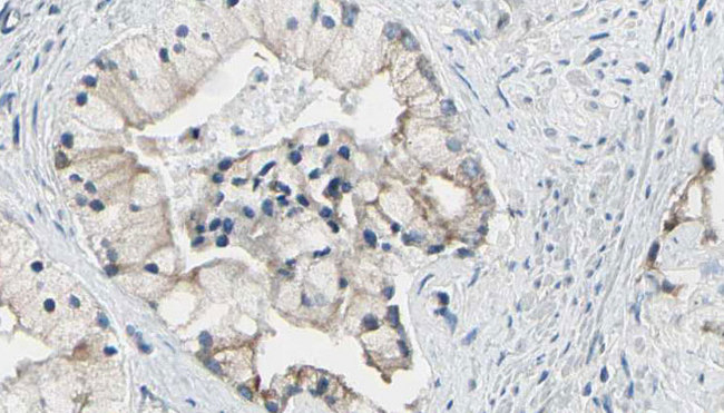 TRIM29 Antibody - 1:100 staining human prostate tissue by IHC-P. The sample was formaldehyde fixed and a heat mediated antigen retrieval step in citrate buffer was performed. The sample was then blocked and incubated with the antibody for 1.5 hours at 22°C. An HRP conjugated goat anti-rabbit antibody was used as the secondary.