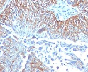 TRIM29 Antibody - IHC testing of FFPE human esophageal carcinoma and TRIM29 antibody (clone TPMP29-1).  This image was taken for the unmodified form of this product. Other forms have not been tested.