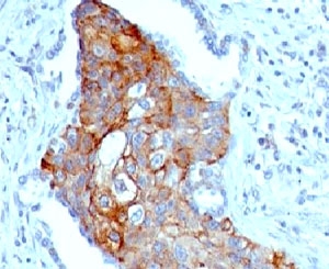 TRIM29 Antibody - IHC testing of FFPE human lung squamous cell carcinoma and TRIM29 antibody (clone TPMP29-1).  This image was taken for the unmodified form of this product. Other forms have not been tested.