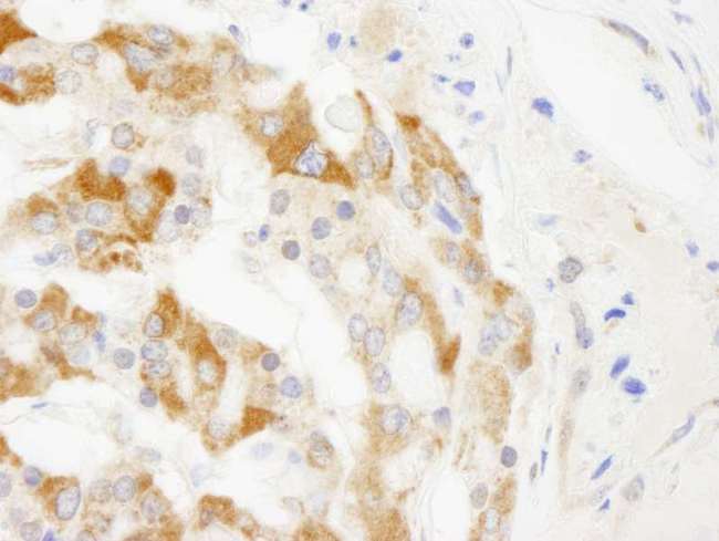 TRIM3 Antibody - FFPE section of human anaplastic thyroid carcinoma.  LS-CC286489 used at a dilution of 1:250. 
