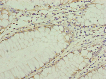 TRIM31 / RNF Antibody - Immunohistochemistry of paraffin-embedded human colon cancer at dilution of 1:100