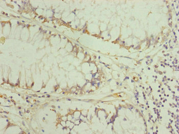 TRIM31 / RNF Antibody - Immunohistochemistry of paraffin-embedded human colon cancer at dilution of 1:100