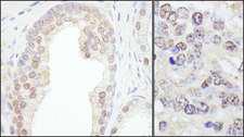 TRIM33 / TIF1-Gamma Antibody - Detection of Human and Mouse TRIM33/TIF1gamma by Immunohistochemistry. Sample: FFPE section of human prostate carcinoma (left) and mouse teratoma (right). Antibody: Affinity purified rabbit anti-TRIM33/TIF1gamma used at a dilution of 1:200 (1 ug/ml). Detection: DAB.