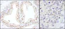 TRIM33 / TIF1-Gamma Antibody - Detection of Human and Mouse TRIM33/TIF1gamma by Immunohistochemistry. Sample: FFPE section of human prostate carcinoma (left) and mouse teratoma (right). Antibody: Affinity purified rabbit anti-TRIM33/TIF1gamma used at a dilution of 1:1000 (1 ug/ml). Detection: DAB.