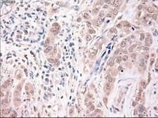 TRIM33 / TIF1-Gamma Antibody - IHC of paraffin-embedded Adenocarcinoma of breast using anti-Trim33 mouse monoclonal antibody.