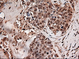 TRIM33 / TIF1-Gamma Antibody - IHC of paraffin-embedded Adenocarcinoma of breast using anti-Trim33 mouse monoclonal antibody.