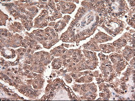 TRIM33 / TIF1-Gamma Antibody - IHC of paraffin-embedded Carcinoma of kidney using anti-Trim33 mouse monoclonal antibody.