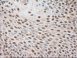 TRIM33 / TIF1-Gamma Antibody - IHC of paraffin-embedded Carcinoma of lung using anti-Trim33 mouse monoclonal antibody.