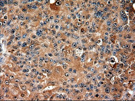 TRIM33 / TIF1-Gamma Antibody - IHC of paraffin-embedded Adenocarcinoma of ovary using anti-Trim33 mouse monoclonal antibody.