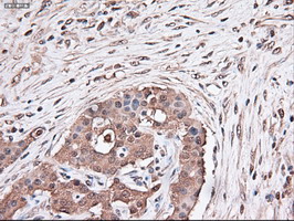 TRIM33 / TIF1-Gamma Antibody - IHC of paraffin-embedded Carcinoma of pancreas using anti-Trim33 mouse monoclonal antibody.