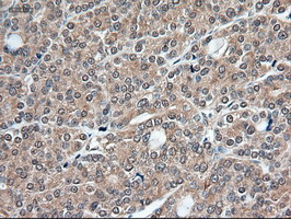 TRIM33 / TIF1-Gamma Antibody - IHC of paraffin-embedded Carcinoma of thyroid using anti-Trim33 mouse monoclonal antibody.