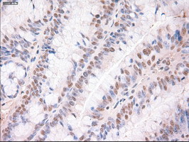 TRIM33 / TIF1-Gamma Antibody - IHC of paraffin-embedded Adenocarcinoma of colon using anti-Trim33 mouse monoclonal antibody.