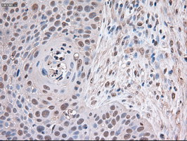 TRIM33 / TIF1-Gamma Antibody - IHC of paraffin-embedded Carcinoma of lung using anti-Trim33 mouse monoclonal antibody.