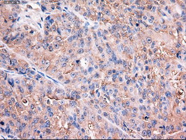 TRIM33 / TIF1-Gamma Antibody - IHC of paraffin-embedded Adenocarcinoma of ovary using anti-Trim33 mouse monoclonal antibody.