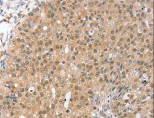 TRIM35 Antibody - Immunohistochemistry of paraffin-embedded Human breast cancer using TRIM35 Polyclonal Antibody at dilution of 1:35.