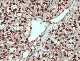 TRIM38 Antibody - IHC of paraffin-embedded Carcinoma of Human kidney tissue using anti-TRIM38 mouse monoclonal antibody.