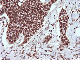 TRIM38 Antibody - IHC of paraffin-embedded Carcinoma of Human bladder tissue using anti-TRIM38 mouse monoclonal antibody.