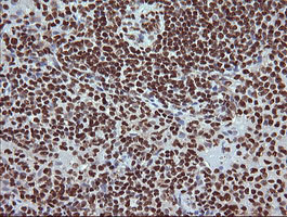 TRIM38 Antibody - IHC of paraffin-embedded Human lymphoma tissue using anti-TRIM38 mouse monoclonal antibody.